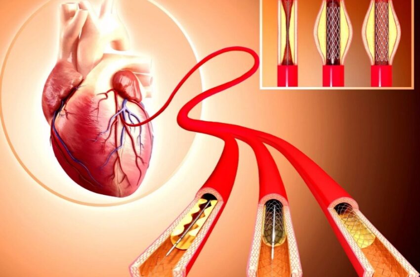  Anju nədir? Stent necə qoyulur? – MÜDDƏTİ